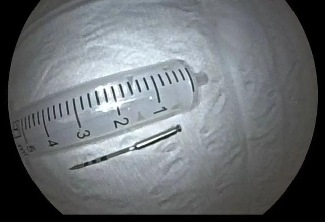 万万没想到！滑进喉咙消失了？男子吓懵：医生没敢告诉我……