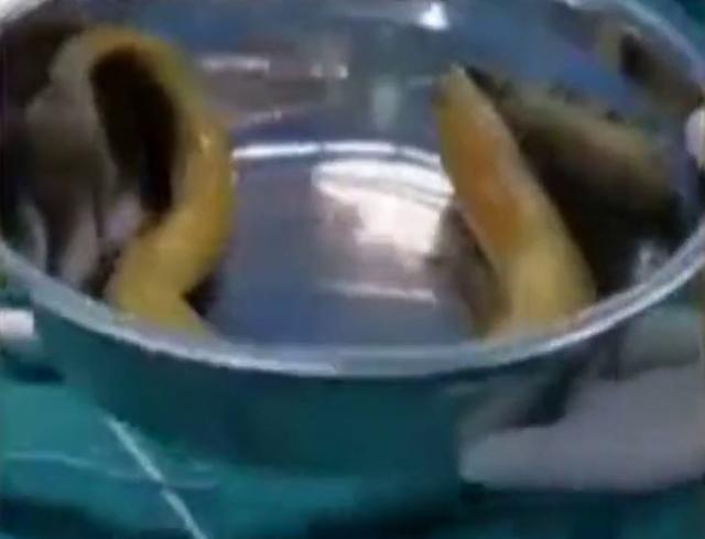 男子为治便秘将黄鳝塞进肛门,穿破直肠命悬一线