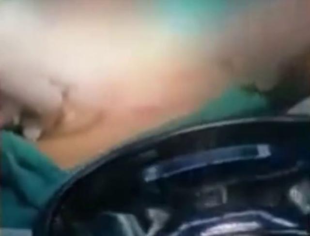 男子为治便秘将黄鳝塞进肛门，穿破直肠命悬一线