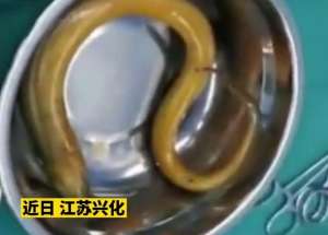 女主播肛门塞黄鳝(男子为治便秘将黄鳝塞进肛门，穿破直肠命悬一线)