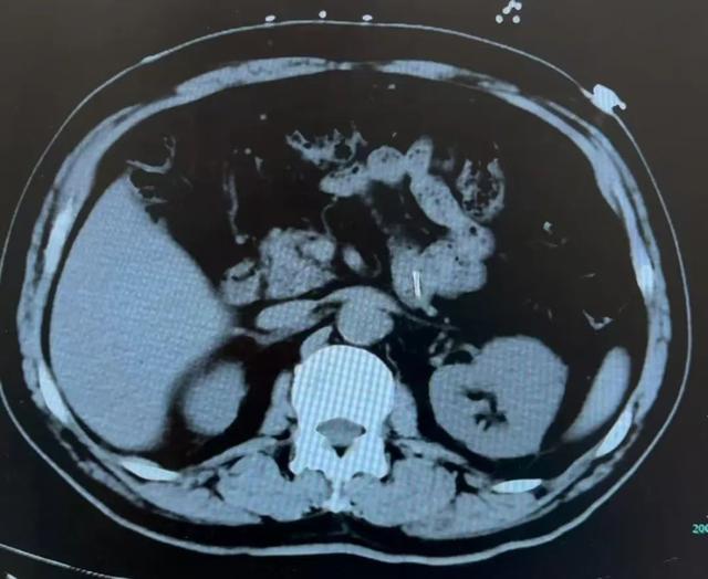 万万没想到！滑进喉咙消失了？男子吓懵：医生没敢告诉我……