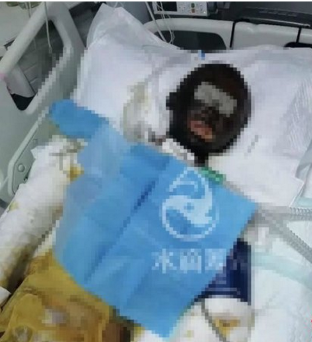 网红女主播直播时前夫泼汽油持打火机引爆，汽油淋身她大喊让爸爸快跑，全身90%烧伤，后续治疗还需几百万