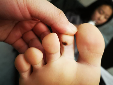 全国网友都在看自己的脚底板！医生：长了这个要人命