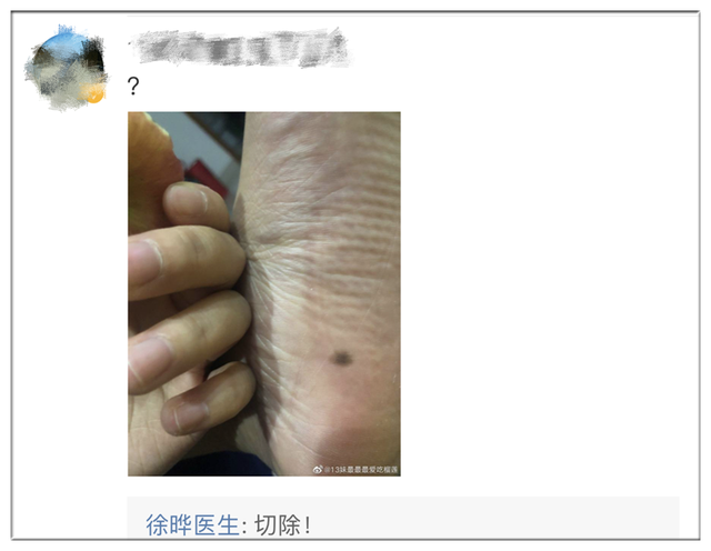全国网友都在看自己的脚底板！医生：长了这个要人命