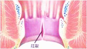 女主播屁眼(连续熬夜直播三个月后，网红女主播肛裂排便困难)