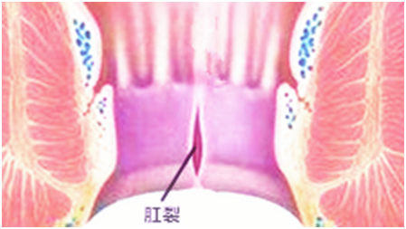 连续熬夜直播三个月后，网红女主播肛裂排便困难