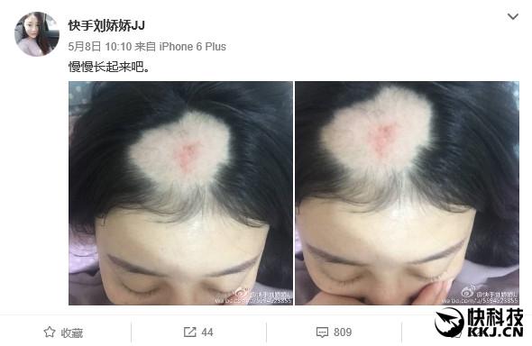 美女电钻啃玉米变秃顶去看医生:真悲剧了