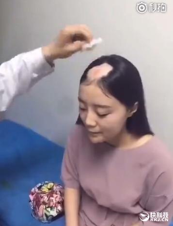 美女电钻啃玉米变秃顶去看医生:真悲剧了