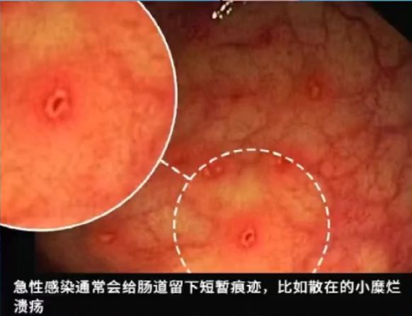 这种息肉可能会变成癌！排便出现这4种异常建议及时就医