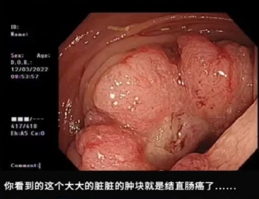 这种息肉可能会变成癌！排便出现这4种异常建议及时就医