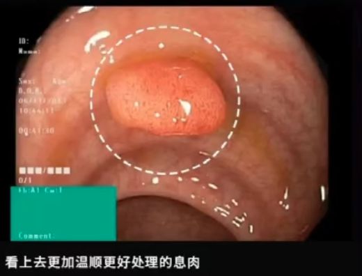 这种息肉可能会变成癌！排便出现这4种异常建议及时就医