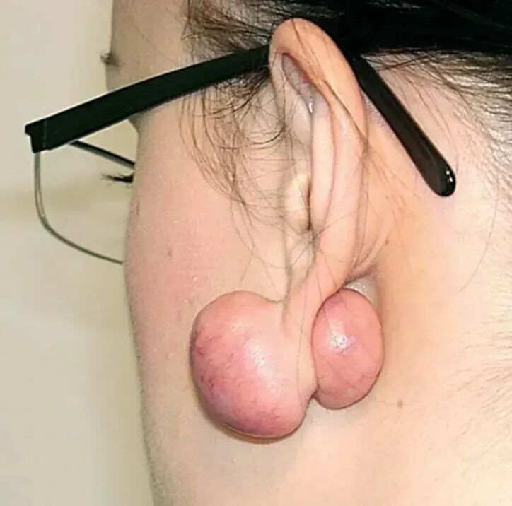 为什么没有人告诉我，打耳洞后会长这种肉疙瘩啊？